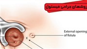 عمل جراحی فیستول به چند روش انجام می‌شود؟