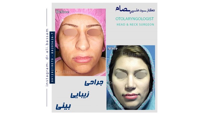 عمل بینی گوشتی عمل بینی گوشتی
