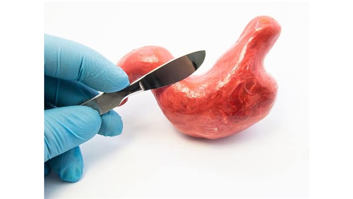 آری یا خیر به عمل اسلیو معده؟!