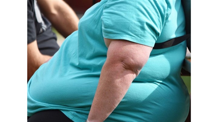 آری یا خیر به عمل اسلیو معده؟!