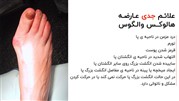 هالوکس والگوس شست پا چیست و چگونه درمان می‌شود؟ 