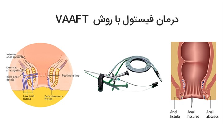 درمان فیستول مقعدی با روش VAAFT در ایران کلینیک درمان فیستول مقعدی با روش VAAFT در ایران کلینیک
