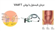 درمان فیستول مقعدی با روش VAAFT در ایران کلینیک