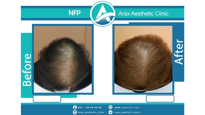 آشنایی با دکتر ماهور طباطبایی، بنیان‌گذار روش درمان ریزش موی NFP در ایران