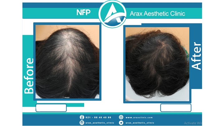 کلینیک آراکس روش درمان قطعی ریزش مو به نام NFP را در ایران عرضه کرد