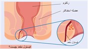 فیستول چیست؟
