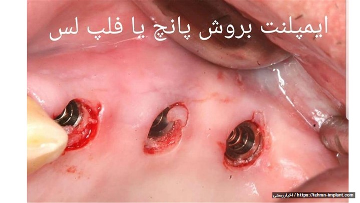 روش ایمپلنت بدون جراحی یا فلپ لس