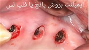 روش ایمپلنت بدون جراحی یا فلپ لس