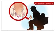 تاثیر رابطه مقعدی در ایجاد یا بازگشت بواسیر یا هموروئید 