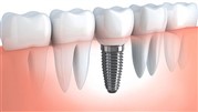 شرایط و نکات مهم کاشت ایمپلنت های دندانی