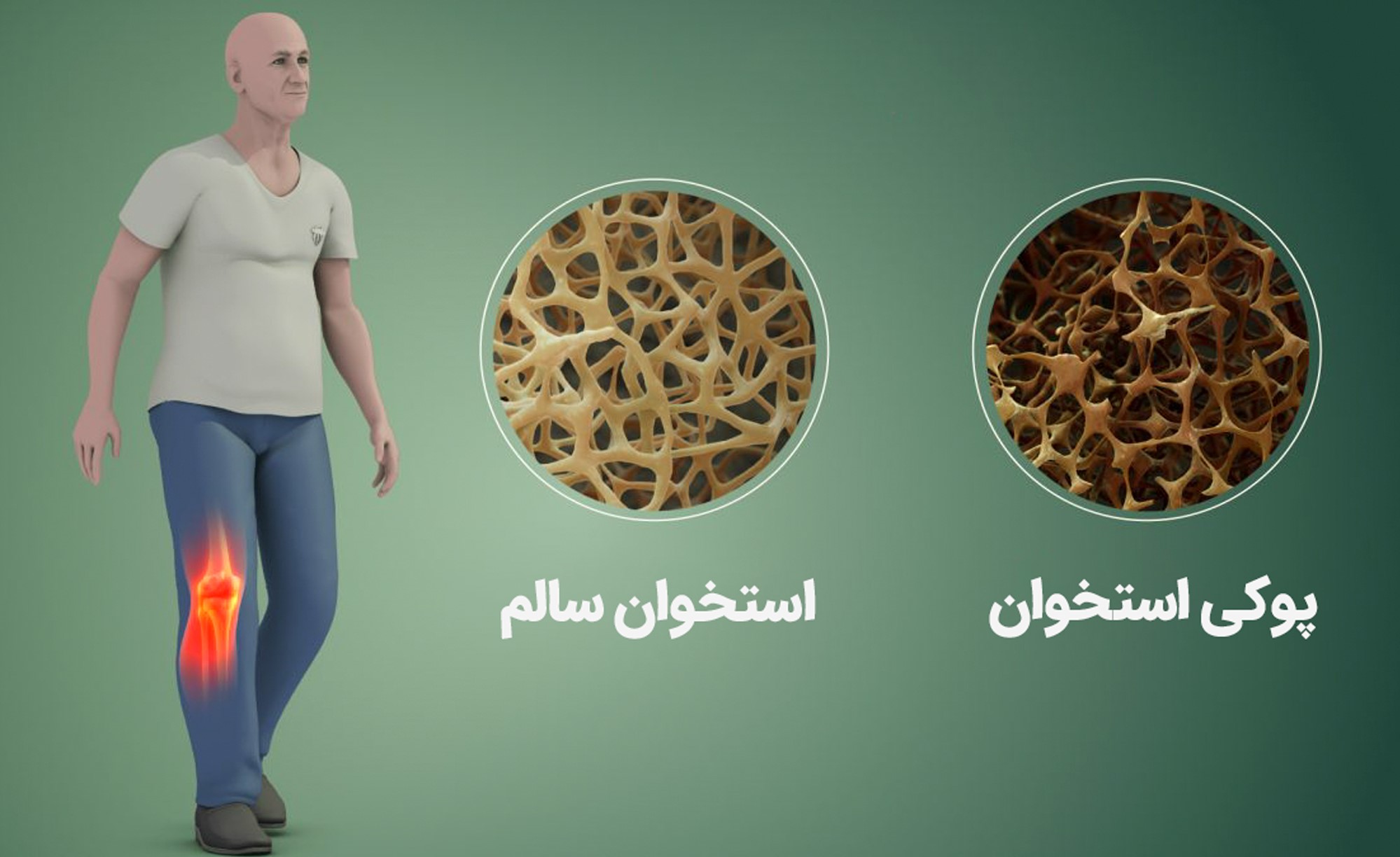 پوکی استخوان درمان ندارد، تنها راه، پیشگیری با کلسیم کافی است