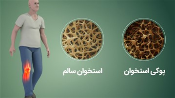 پوکی استخوان درمان ندارد، تنها راه، پیشگیری با کلسیمِ کافی است پوکی استخوان درمان ندارد، تنها راه، پیشگیری با کلسیمِ کافی است