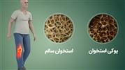پوکی استخوان درمان ندارد، تنها راه، پیشگیری با کلسیمِ کافی است
