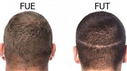 کدام روش کاشت مو بهتره؟ FUT یا FUE