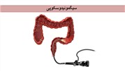 انجام آزمایش سیگموئیدوسکوپی برای تشخیص بیماری‌های روده