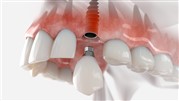 بررسی ایمپلنت دندان فوری و کاربرد آن