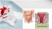 علائم بواسیر خونی و بهترین روش‌های درمان این بیماری