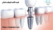 قیمت کاشت و ایمپلنت دندان
