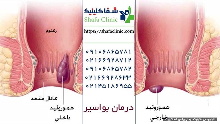 چرا درمان بواسیر، شقاق و سایر بیماری‌های نشیمنگاهی با لیزر پیشنهاد می‌شود؟