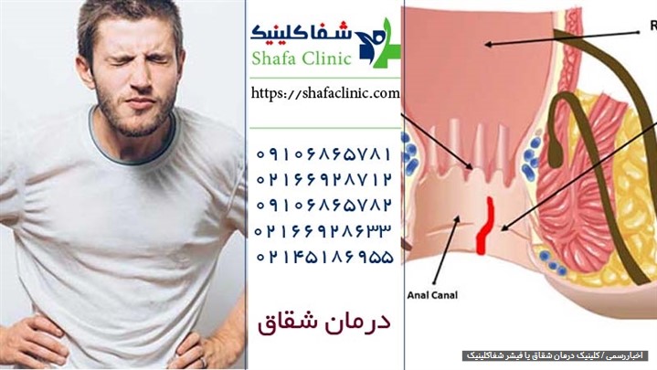 چرا درمان بواسیر، شقاق و سایر بیماری‌های نشیمنگاهی با لیزر پیشنهاد می‌شود؟