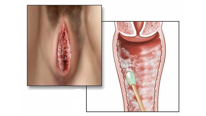 ر وش های خانگی درمان عفونت واژن 