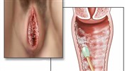 ر وش های خانگی درمان عفونت واژن 