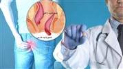 علائم بواسیر داخلی درجه ۱،۲،۳ و ۴ چیست؟