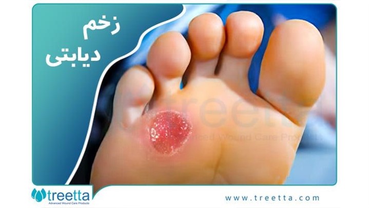 دیابت چیست؟ پیش دیابت، علائم، زخم پای دیابتی/ نشانه ها و انواع آن 2022 دیابت چیست؟ پیش دیابت، علائم، زخم پای دیابتی/ نشانه ها و انواع آن 2022