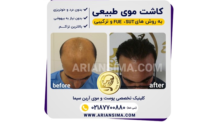 خدمات کاشت مو و کاشت ابرو در کلینیک زیبایی آرین سیما خدمات کاشت مو و کاشت ابرو در کلینیک زیبایی آرین سیما