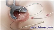 درمان فیستول مقعدی با لیزر در یک جلسه 