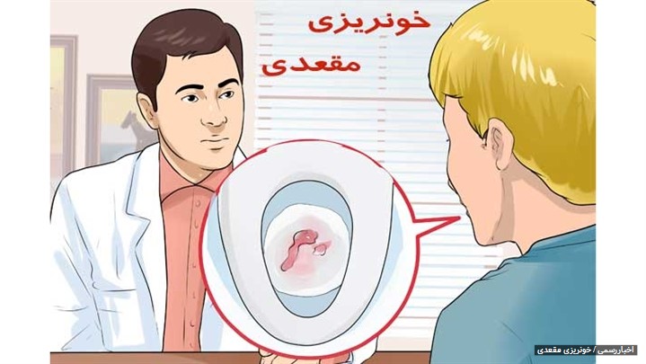 خونریزی مقعد چه علائمی دارد؟ خونریزی مقعد چه علائمی دارد؟