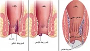 بررسی شکل ظاهری بواسیر خارجی و داخلی در زنان و مردان