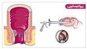 استفاده از روش پروکتوسکوپی برای تشخیص و درمان بواسیر یا هموروئید داخلی