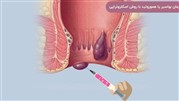 درمان بواسیر یا هموروئید بدون عمل جراحی با روش اسکلروتراپی