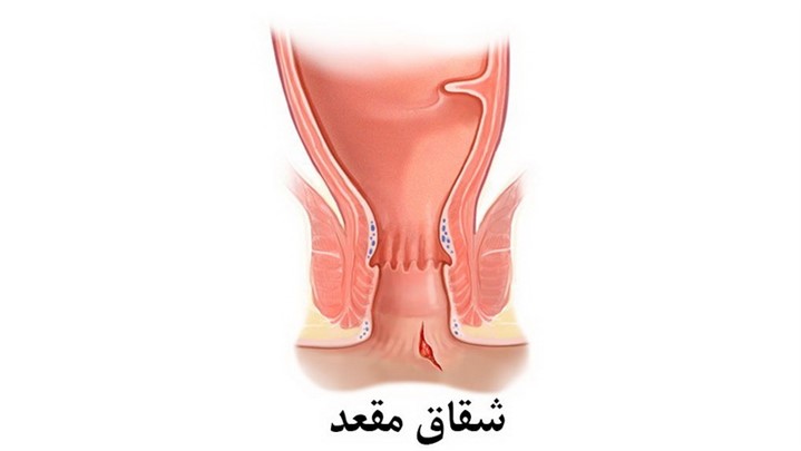 شقاق و فیشر مقعدی شقاق و فیشر مقعدی