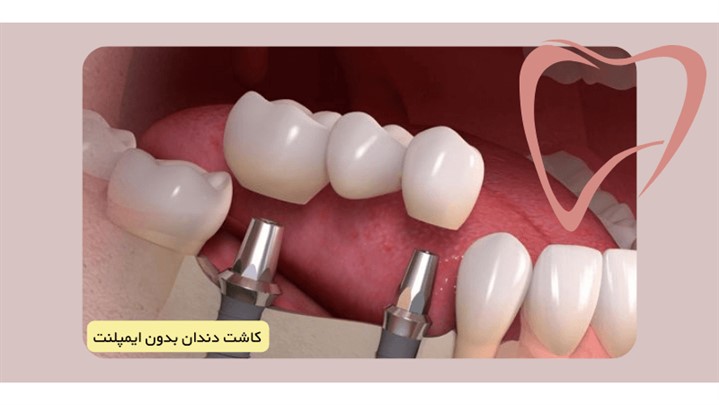 کاشت دندان بدون ایمپلنت چگونه است؟