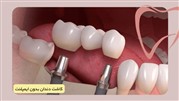 کاشت دندان بدون ایمپلنت چگونه است؟