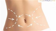 راز داشتن شکمی صاف و تخت با عمل ابدومینوپلاستی