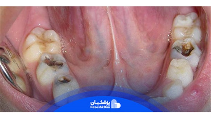 قاتل دندان درد | درمان سه سوته دندان درد