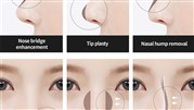 انواع جراحی بینی و مزیایا و معایب آنها