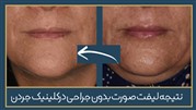 لیفت صورت با روش های غیر تهاجمی کم خطر