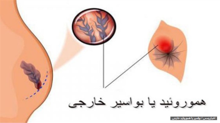 درمان سریع بواسیر خارجی (هموروئید خارجی) بدون جراحی درمان سریع بواسیر خارجی (هموروئید خارجی) بدون جراحی