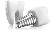 در مورد فیکسچر دندان بیشتر بدانید (ایمپلنت دندان)