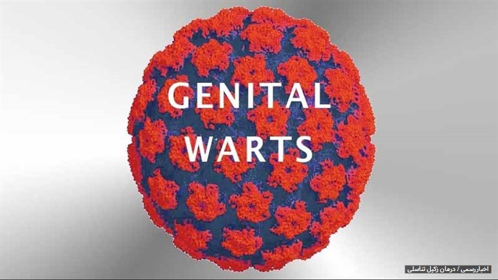 درمان زگیل تناسلی (hpv) با لیزر و کرایو + هزینه درمان زگیل تناسلی (hpv) با لیزر و کرایو + هزینه
