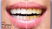 بلیچینگ دندان در تهران