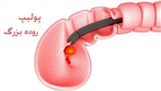 پولیپ روده بزرگ چیست؟ چه علائمی دارد و چگونه درمان می‌شود؟