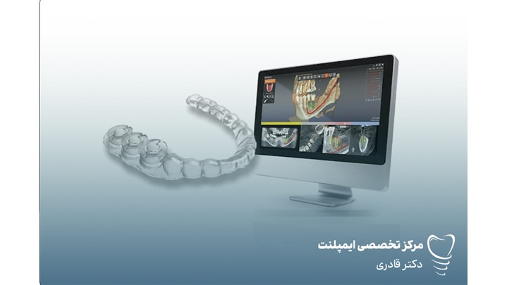 قیمت ایمپلنت دیجیتال در تهران: بررسی عوامل مؤثر و مزایای این روش نوین