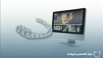 قیمت ایمپلنت دیجیتال در تهران: بررسی عوامل مؤثر و مزایای این روش نوین