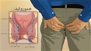 درمان قطعی بواسیر (هموروئید) با لیزر و بدون عمل جراحی