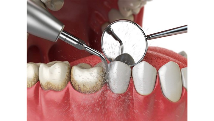 انواع مشکلات دندان و راه درمان